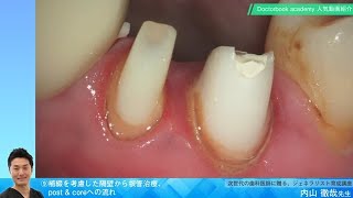 【Doctorbook academy 人気動画紹介】⑨補綴を考慮した隔壁から根管治療、post \u0026 coreへの流れ