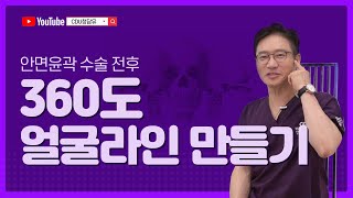 CDU리얼상담_360도 얼굴라인 만들기(안면윤곽수술 전후)