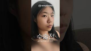 쌍수+코수술+안면윤곽(광대,사각턱) #shorts