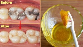 एक बार में दांत का कीड़ा और दर्द बाहर निकालने का बेहतरीन उपाय - How To Get Rid Of Tooth Cavity