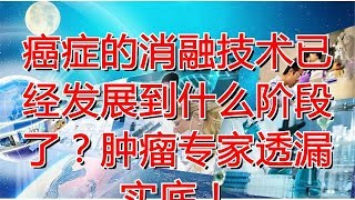 癌症的消融技术已经发展到什么阶段了？肿瘤专家透漏实底！