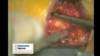 Lumbar Microdiscectomy - Brian D. Rudin, M.D.