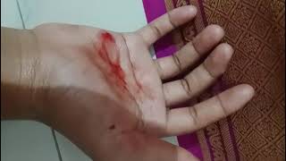 పంచ గాయాలు పొందిన బాలిక. రామాపురం, కడప. A candidate receives Stigmata.