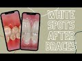 White Spots After Braces #shorts