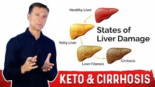 Why a Fatty Keto (Ketogenic) Diet Can Help Reverse a Fatty Liver – Dr. Berg