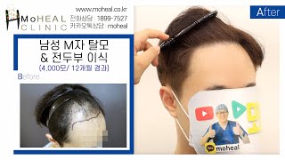 [모힐TV]👨🏻‍🦲남성 모발이식 / 4,000모 M자탈모 & 전두부 이식 12개월 경과💆🏻‍♂️