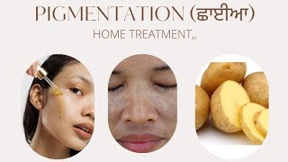 Pigmentation (ਛਾਂਈਆ) ਦਾ ਪੱਕਾ ਹੱਲ