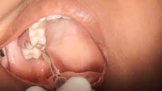 live- sectioning upper molar and using coupland to remove grossly decayed