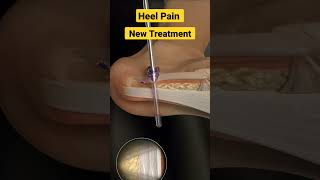 New Treatment Method for Heel Pain✓✓✓