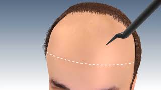 Step by Step FUE Hair Transplant Surgery in jaipur | Hair transplant in india | Outbloom clinics