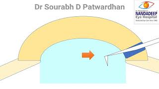 CCC through main incision: thinking process