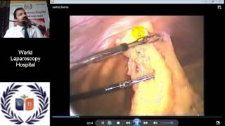 Lecture on Laparoscopic Repair of Ventral Hernia by Dr. R.K. Mishra