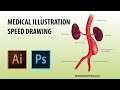 Medical Illustration Timelapse |Abdominal Aortic Aneurysm|Graphical Abstract|Anatomy Illustration