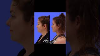 Facial Liposculpture Before And After | Avance Plastic Surgery Institute: Dr. Erez Dayan | Reno, NV