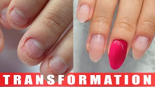 Extremely Bitten Nails PART 3! 😱 INCREDIBLE Transformation On Bitten Nails | A Nail Biter's Journey