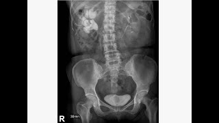 【衛教投影片】經皮氣球擴張腎臟造瘻取石手術 Percutaneous nephrolithotomy (PCNL)