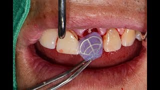 Immediate Implant Placement \u0026  Minimally Invasive Horizontal Ridge Augmentation : Part 1