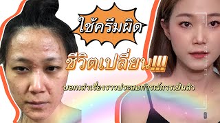 EP.1 ใช้ครีมจนหน้าพัง ทำยังไงให้สิวหาย | tongsimm