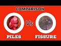 Comparison - PILES Vs FISSURE - ( English Language )