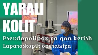 YARALI KOLIT, psevdopolipoz va qon ketish asorati bilan. YANGI DAVOLASH USULI klinikamizda