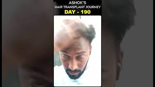 #AskDrJohnWatts | DAY - 190 of ASHOK’S HAIR TRANSPLANT JOURNEY | #besthairtransplant #drjohnwatts