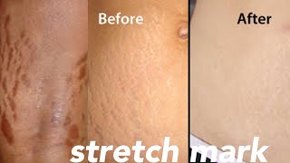 stretch marks on body Sida dildilaca jira loga babiyo stretch mark //safa beauty