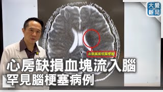 心房缺損血塊流入腦 罕見腦梗塞病例