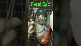 Amniotic Sac//Fetal Sac//Nursing Training