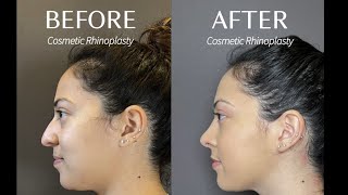 Before and after cosmetic closed scarless Rhinoplasty.