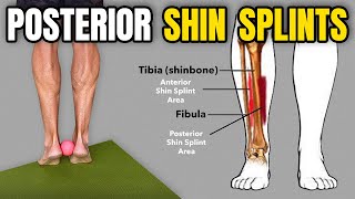 3 Rehab Exercises for Posterior Shin Splints