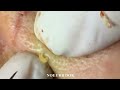 popping tons of blackheads part 181