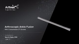 Arthroscopic Ankle Fusion With Compression FT Screws