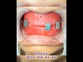 WDC_FIKSASI FULL DENTURE #wdc #shorts #dentist