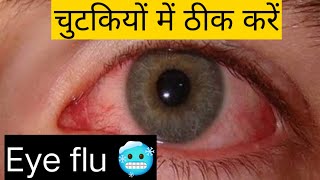 eye flu ko kaise thik kare | eye flu hone par kya karen | eye flu hone pr gharelu upay 2023