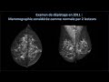 Dr. Gräwingholt Case Study with ProFound AI 2D Mammography