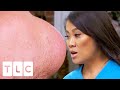 Dr Lee's HEAVIEST Lipoma Breaks The Internet! | Dr Pimple Popper