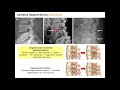 14.4 imagenología de los cambios degenerativos de la columna vertebral y osteoporosis