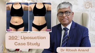 Top PLASTIC Surgeon Reveals Best 360° Liposuction Results | Liposuction Before \u0026 After