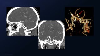 Clipping of Superior Cerebellar Artery and Basilar Bifurcation Aneurysms