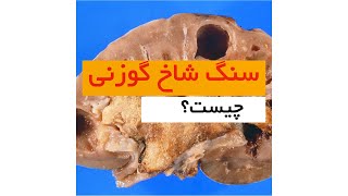 سنگ شاخ گوزنی - دکتر سید امین میرصادقی