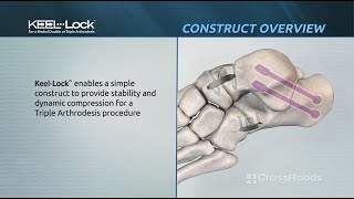 Keel-Lock™ Implant System - Triple Arthrodesis Surgical Technique Animation