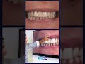 Estratégia para Clareamento de Dente Escuro #resinascompostas #estetica