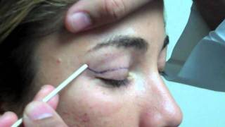 Dr. Jeffrey Epstein - Mark-Up for Upper Eyelid Blepharoplasty - Female Patient