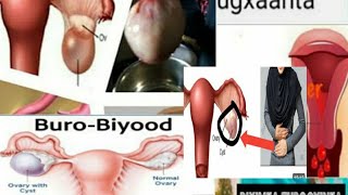 Waa Maxay buro biyood ka Ovarain cyst?pcos Caado wareerka What Can Cause Ovarian Cysts?