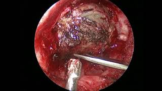 Supraorbital key hole 4 mieloid sarcoma