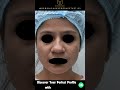 Rhinoplasty Surgery in Delhi | Nose Surgery Before and After #shorts #ytshorts #explore #trending