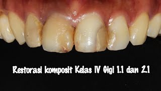 Restorasi Komposit kelas IV Gigi 1.1 dan 2.1 (Komposit Asteria A3B dan Palfique LX5 A2)