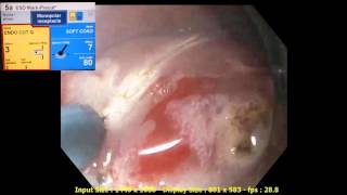 Endoscopic Submucosal Dissection. ClearCut Knife Q type