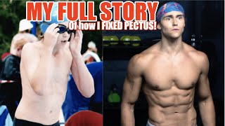My Full Story of How I Fixed My Pectus Excavatum Without Surgery