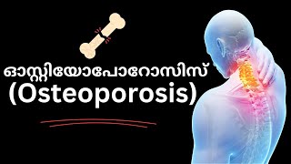 ചലനത്തിനു  പിന്നിൽ - ഓസ്റ്റിയോപോറോസിസ് (Osteoporosis) New Syllabus Kerala Std - 9